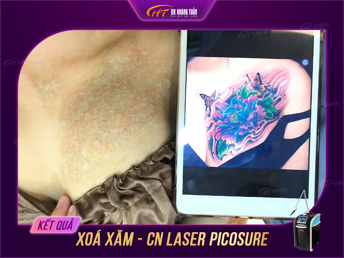 xóa xăm laser có an toàn không